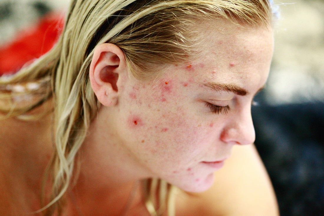 What superfoods are good for acne?